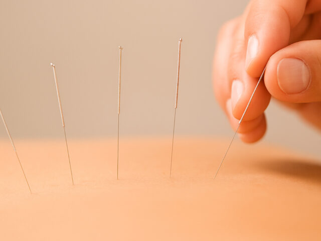 Anxiety Acupuncture Englewood, Colorado