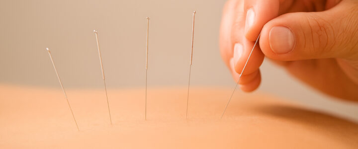 Anxiety Acupuncture Englewood, Colorado